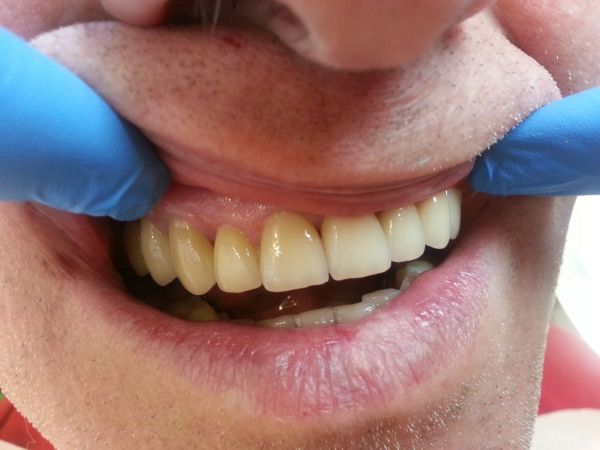 Korony ceramiczne na wszystkich zębach górnych (ceramika na tlenku cyrkonu)